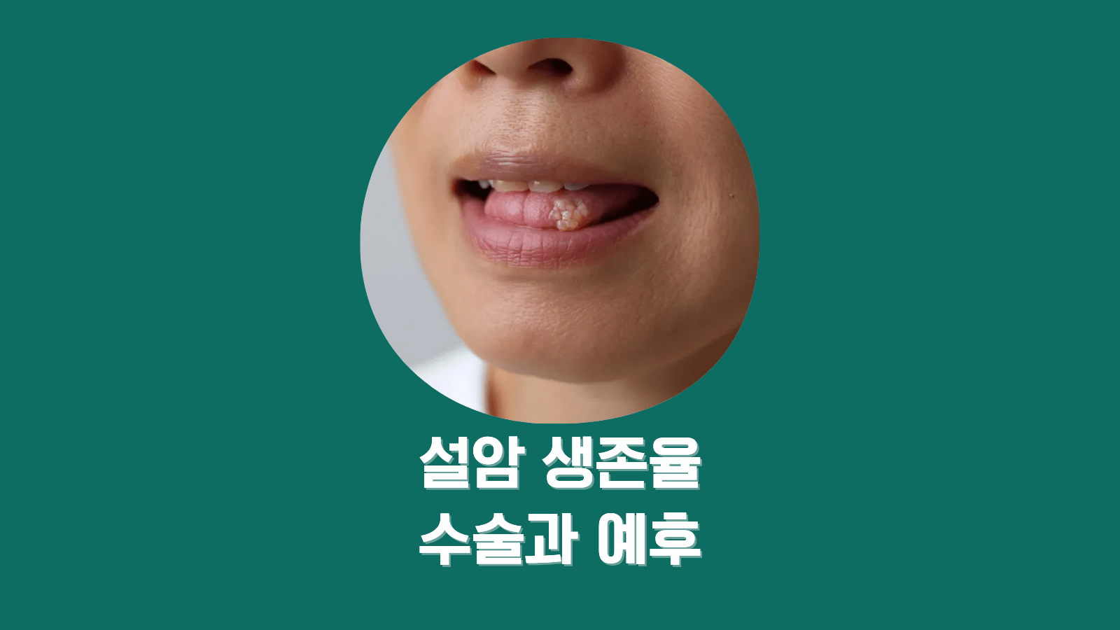 설암 수술 전 반드시 점검할 예후 요인 7가지