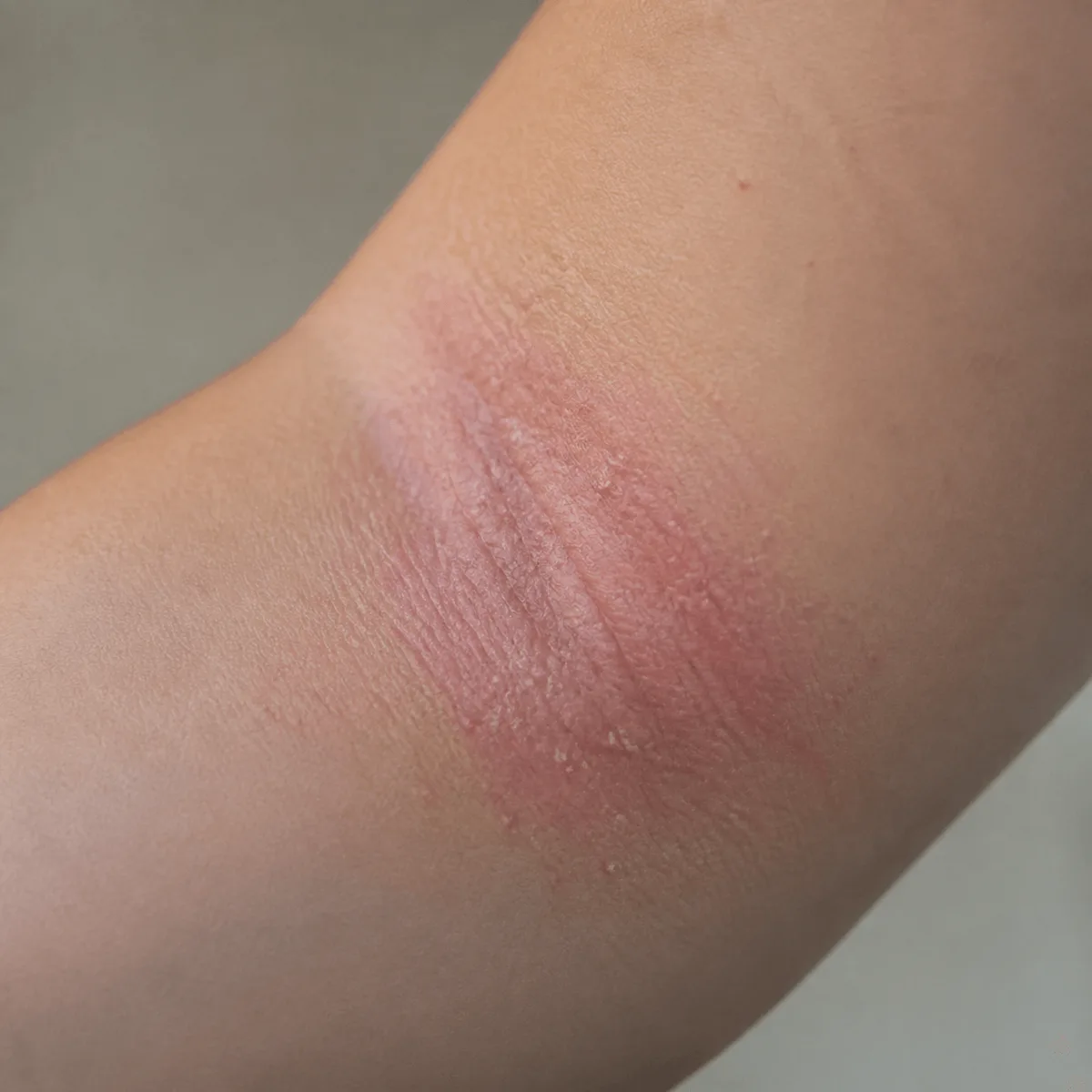 팔 안쪽 접히는 부위에 아토피 초기 증상인 붉은 발진과 건조한 각질이 보이는 피부 클로즈업